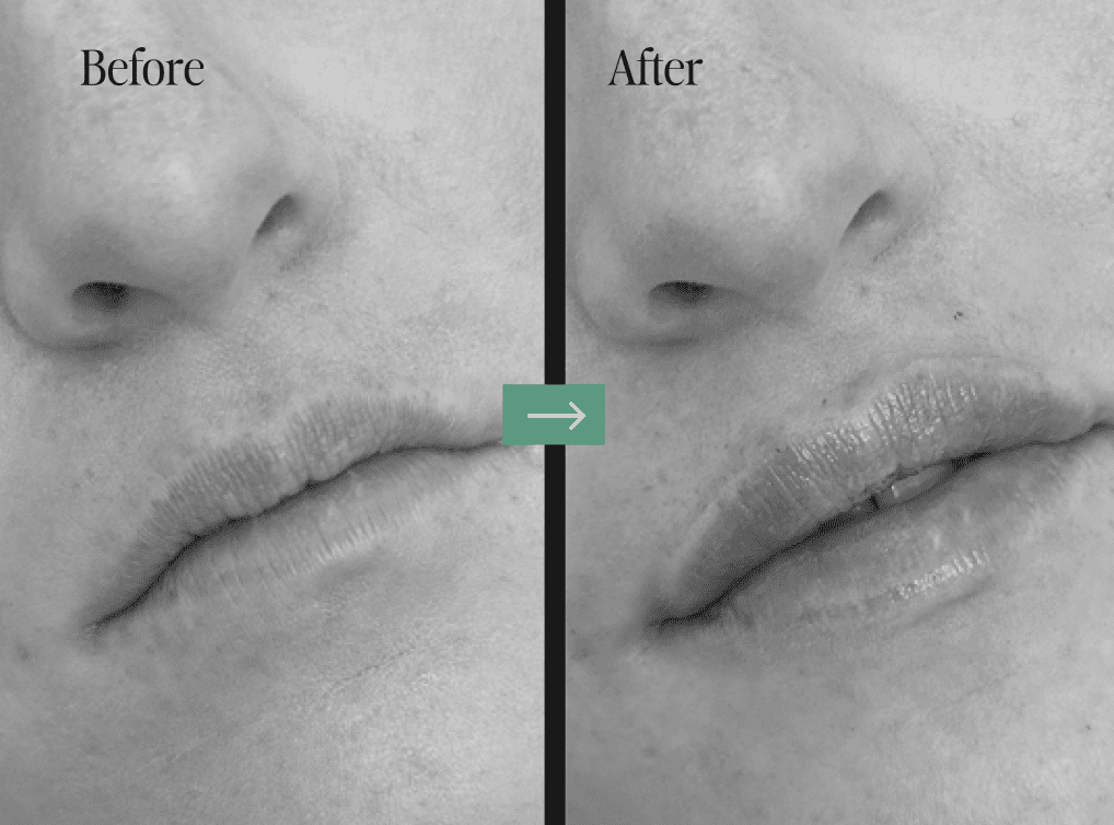Botox Before and After Pictures Charleston, SC